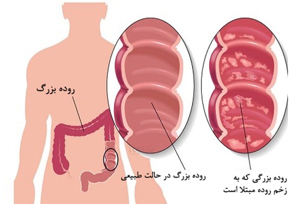 کولیت اولسراتیو چیست؟