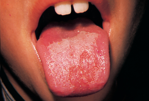 بررسی برخی علل زردی روی زبان