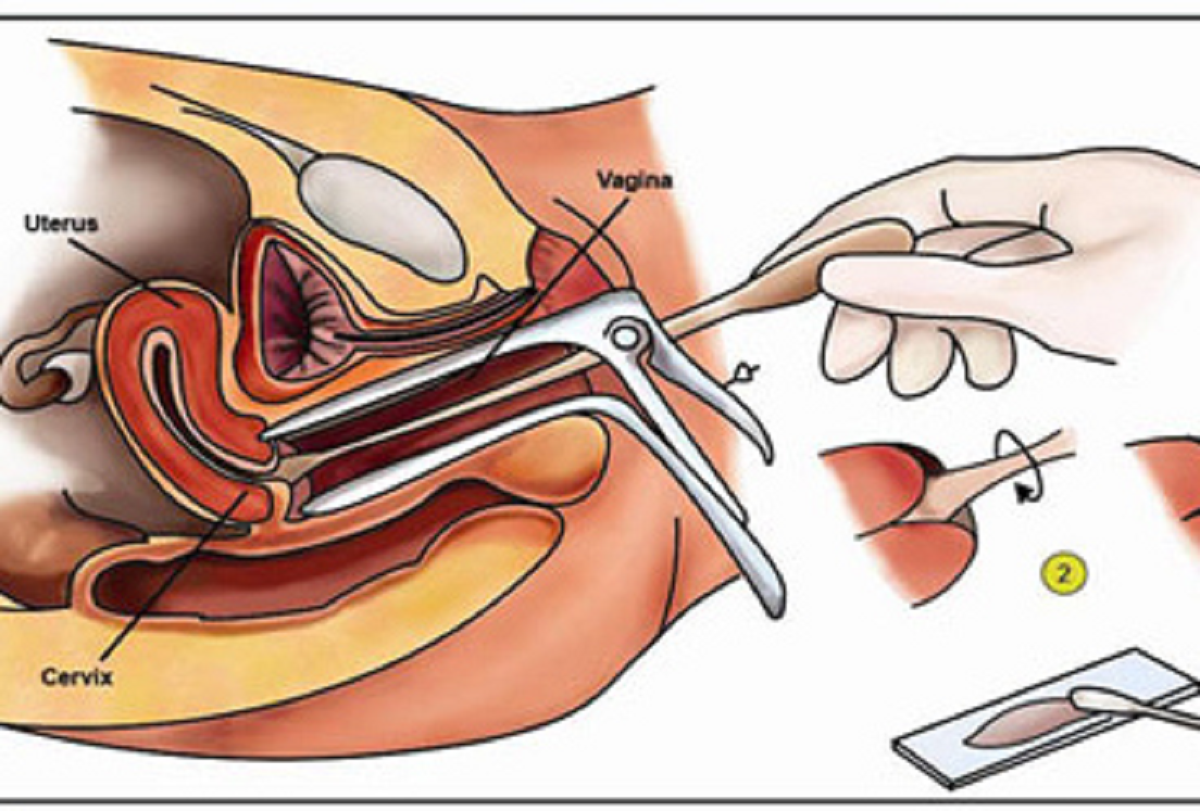 روش تشخیص و درمان زگیل تناسلی در زنان و مردان