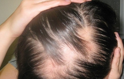 هرآنچه که باید راجع به اختلال کندن مو (تریکوتیلومانیا) بدانیم