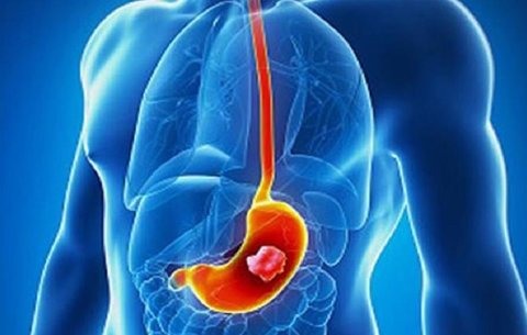 همه چیز در مورد زخم معده و راه حل درمانی آن