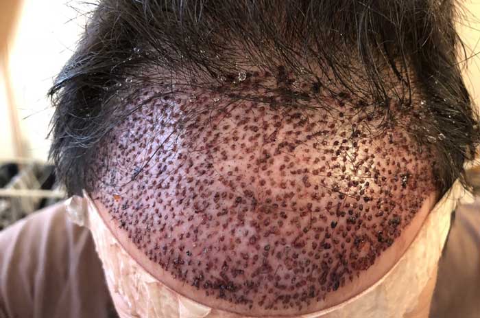 کاشت مو چیست و چه عوارضی دارد؟