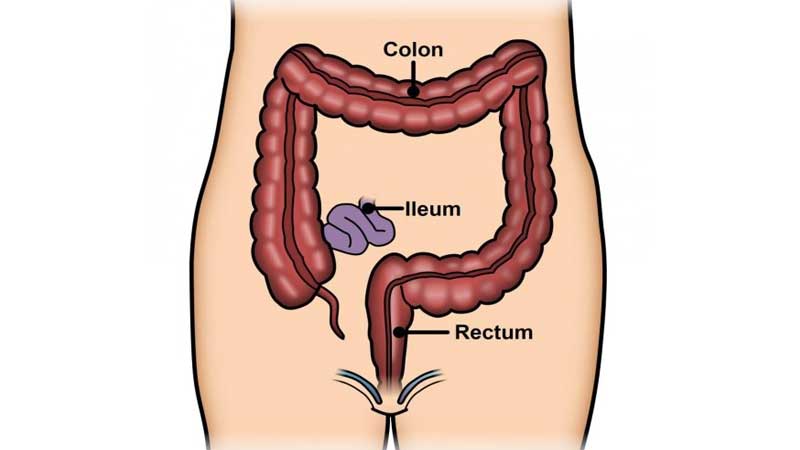 کولیت اولسراتیو چیست؟