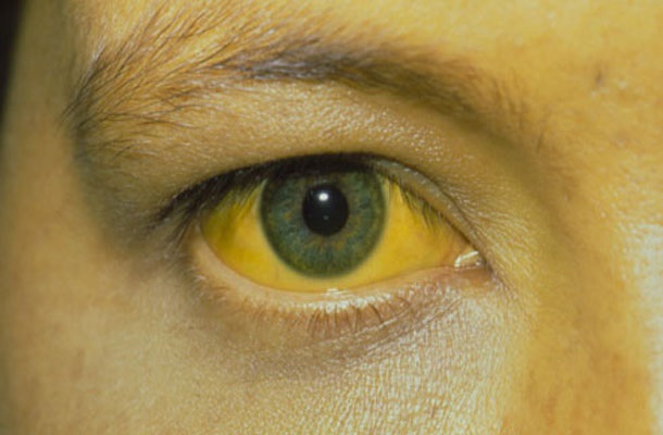 بررسی برخی علل زردی روی زبان