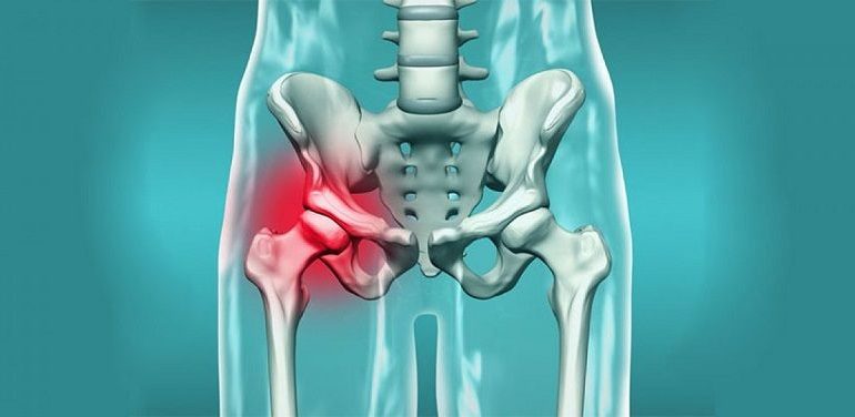 شکستگی لگن چیست و چگونه درمان میشود؟