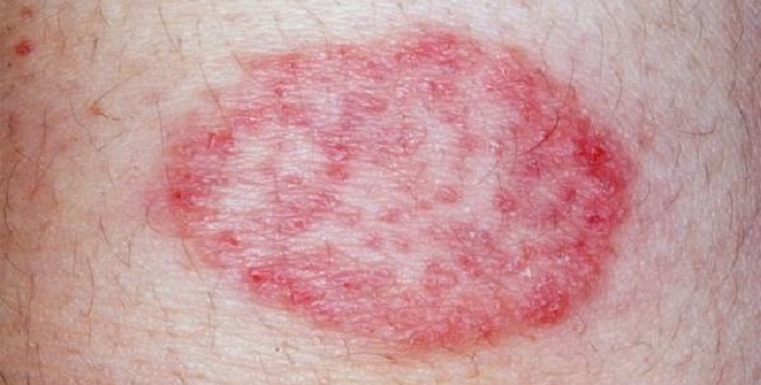 هرآنچه که باید راجع به سرطان پوست بدانیم