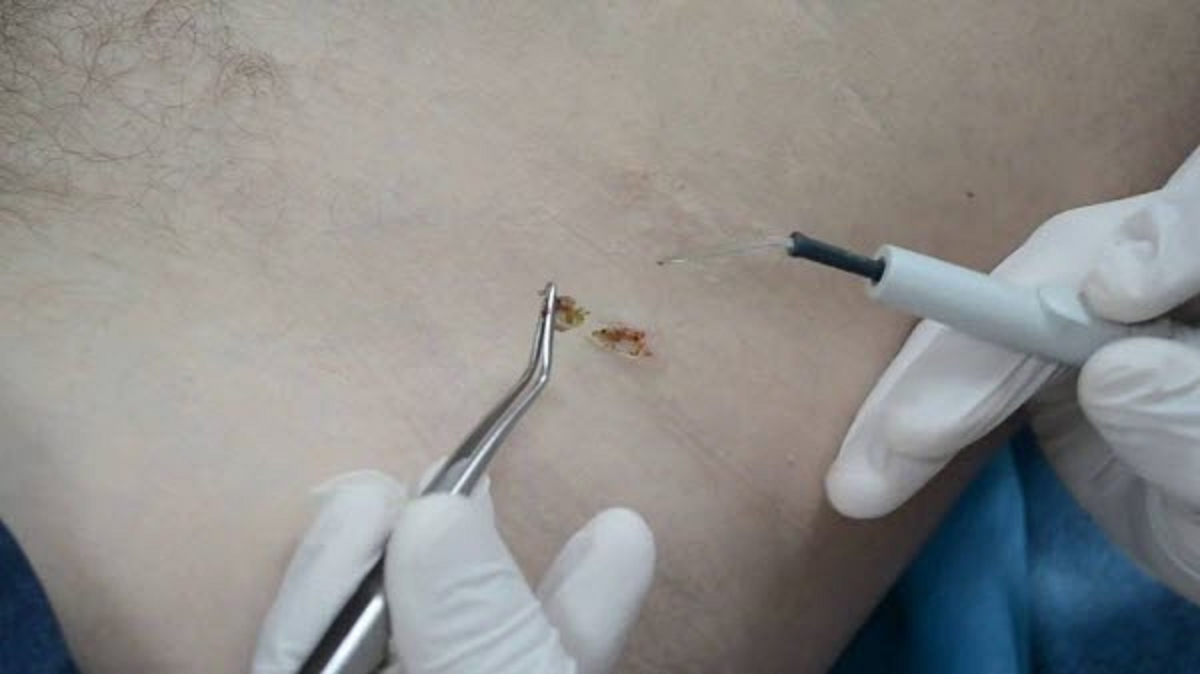 روش تشخیص و درمان زگیل تناسلی در زنان و مردان