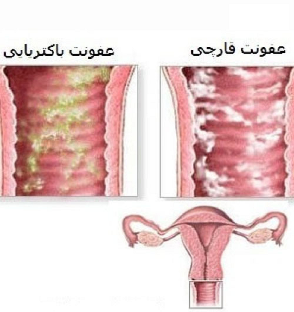 هر آن چیزی که باید در خصوص عفونت در بارداری و تاثیر آن بر جنین بدانیم
