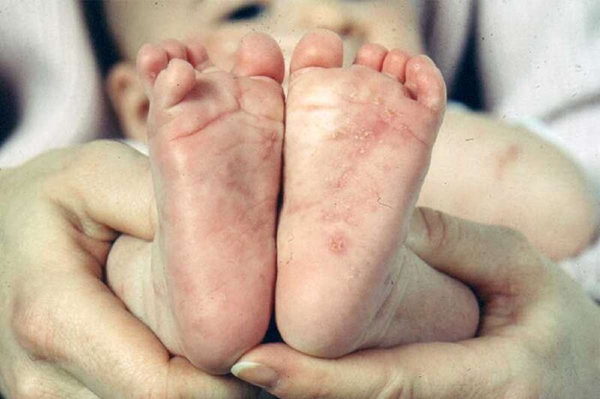 همه چیز راجع به بیماری گال و راه های درمان آن