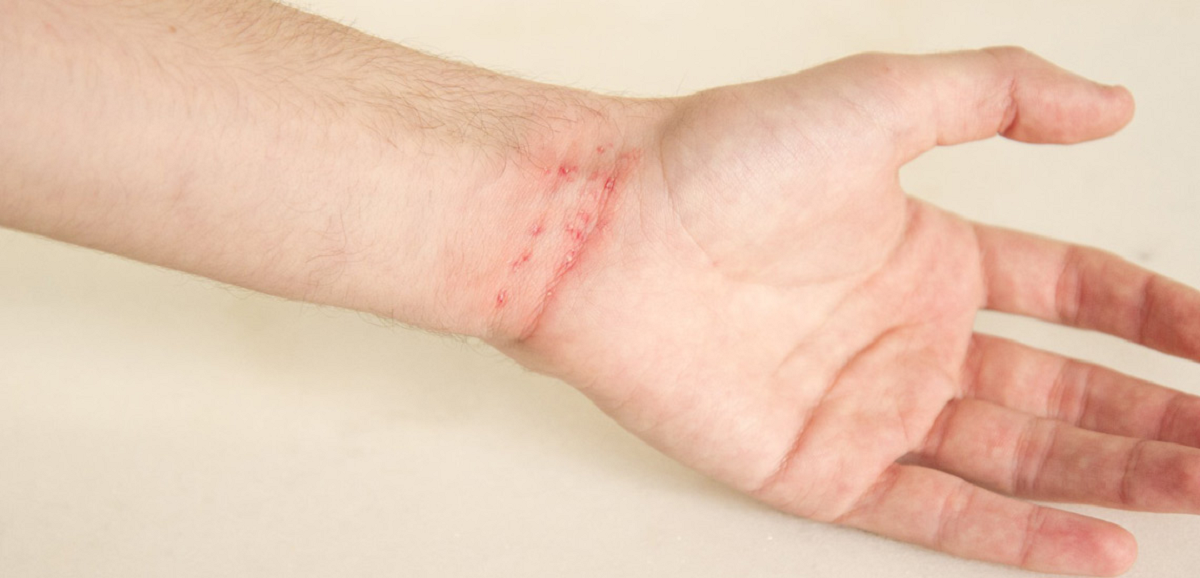 همه چیز راجع به بیماری گال و راه های درمان آن