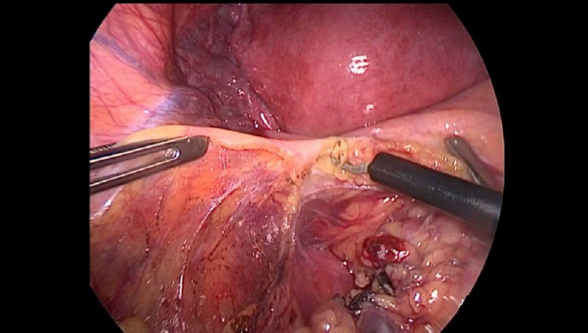 سرطان روده چه علائمی دارد و مراحل تشخیص و درمان آن چگونه است