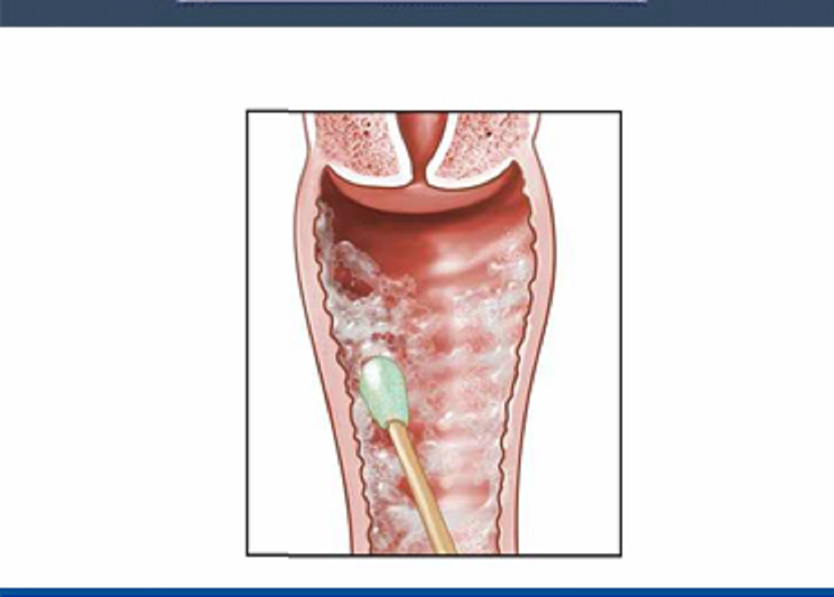 روش های جلوگیری از بروز عفونت های قارچی در زنان و  موثرترین درمان‌های خانگی