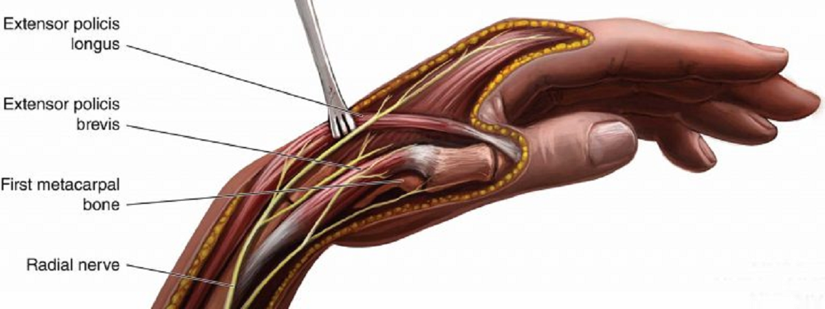 علائم و درمان آسیب های عصب رادیال یا افتادگی مچ دست