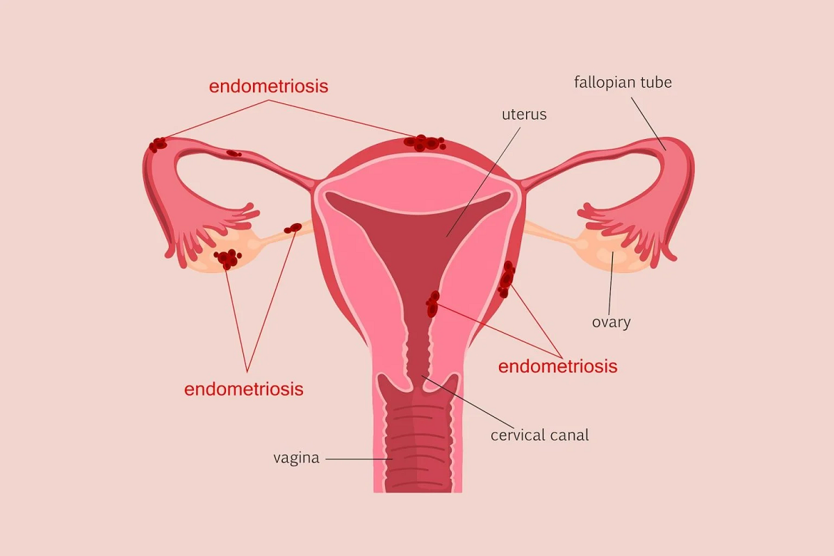 کپسول دانازول و آنچه باید درباره کاربردها و عوارض آن بدانید