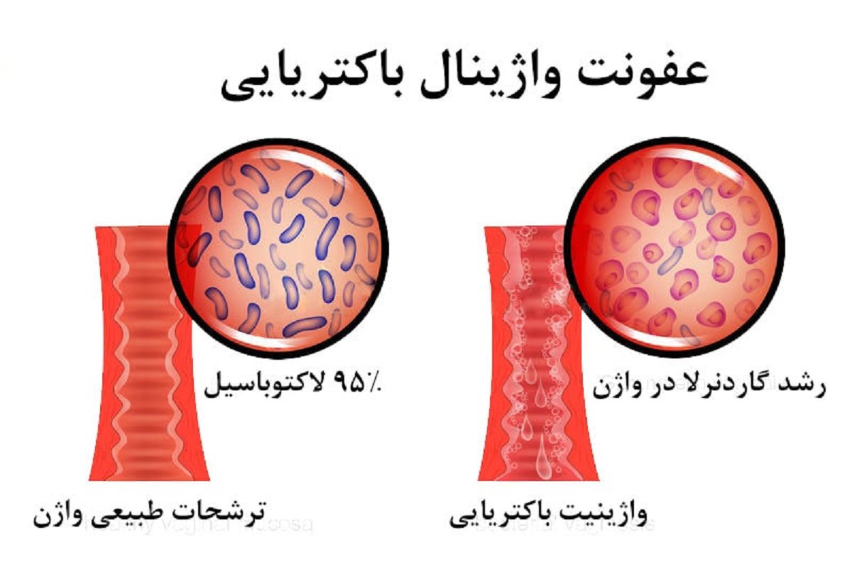 عفونت های واژینال ، از علل بروز تا راه های پیشگیری و درمان آن