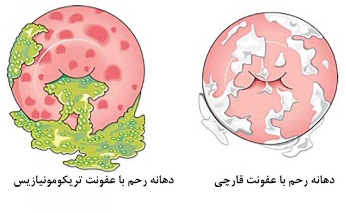 عفونت های واژینال ، از علل بروز تا راه های پیشگیری و درمان آن