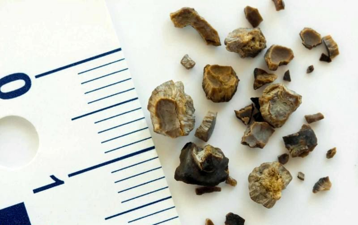 مطالبی که باید در مورد داروی آلوپورینول، تاثیرات و عوارض آن بدانید