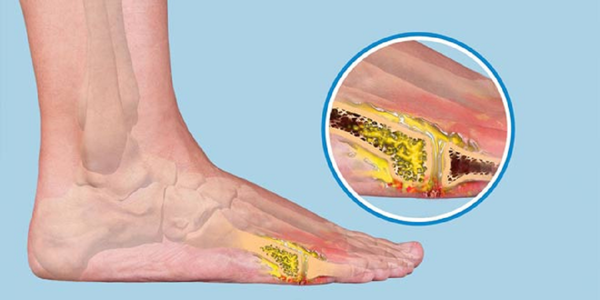 علائم ، علل و درمان بیماری استئومیلیت یا عفونت استخوان