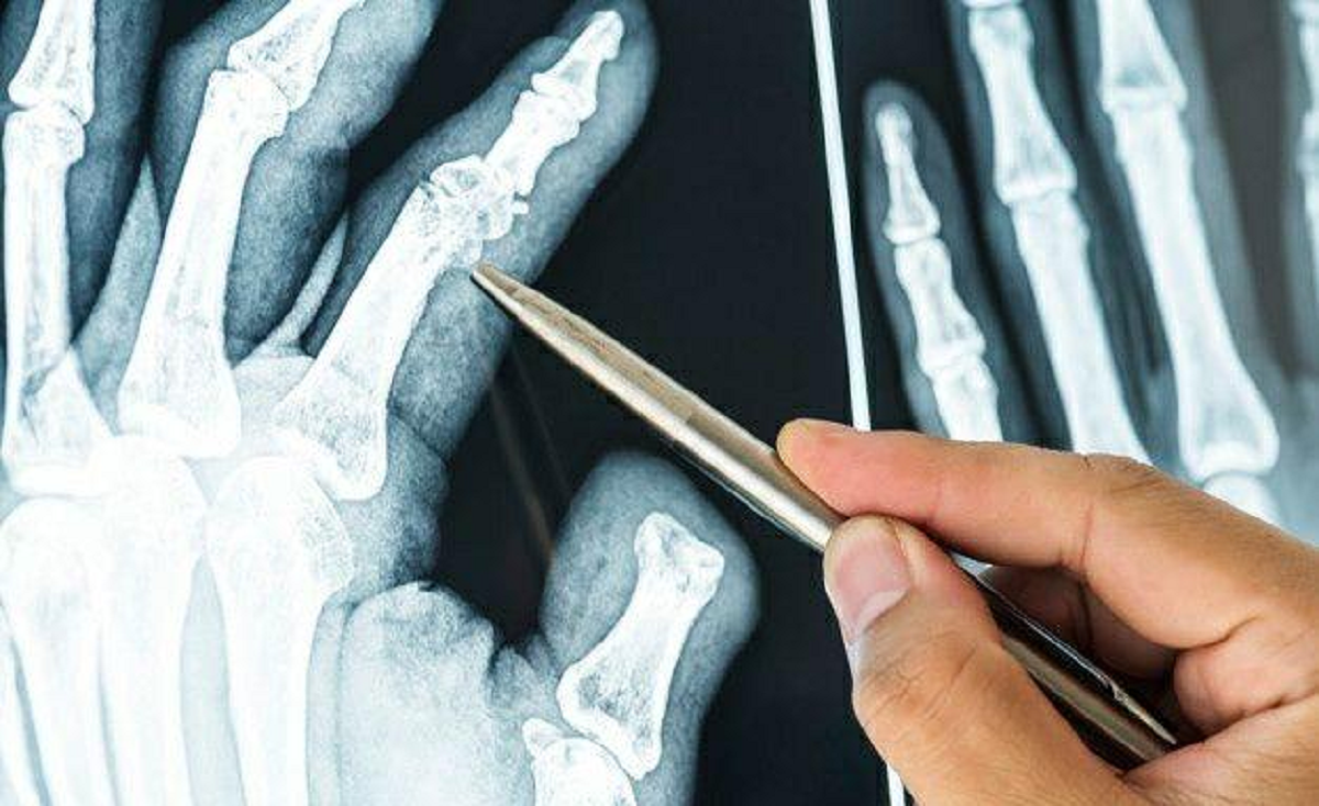 علائم ، علل و درمان بیماری استئومیلیت یا عفونت استخوان