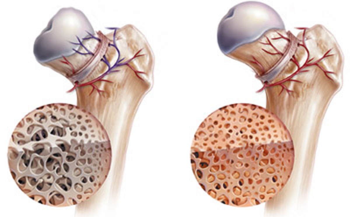 علائم ، علل و درمان بیماری استئومیلیت یا عفونت استخوان