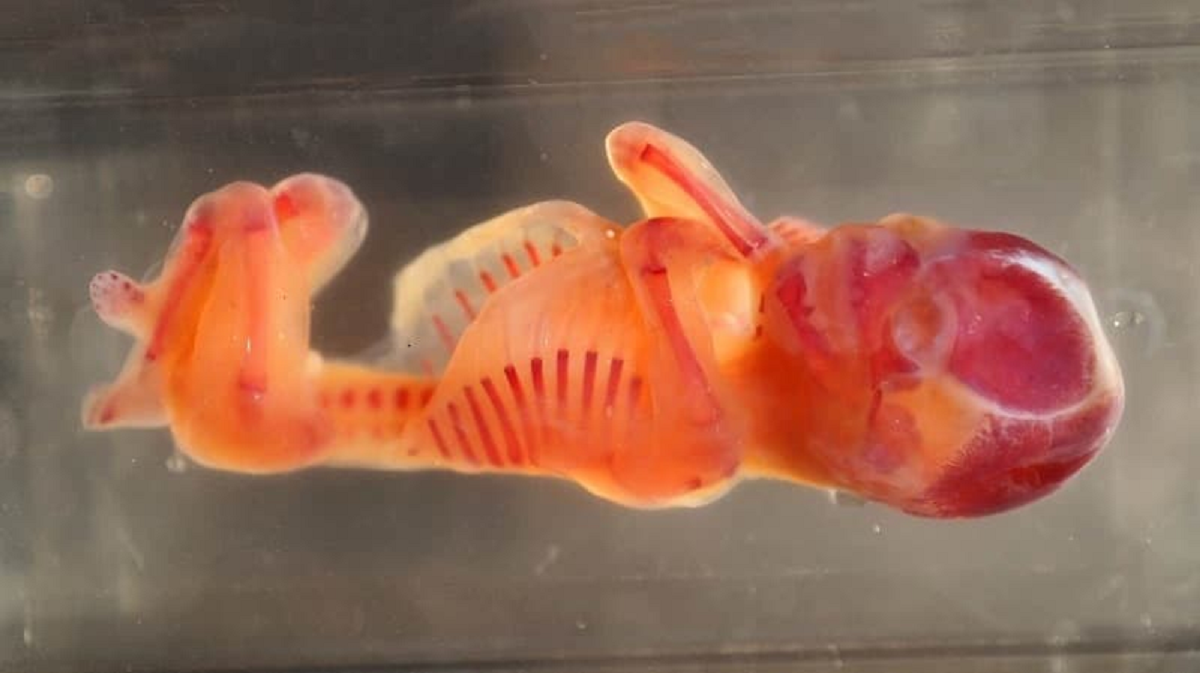 سقط جنین خود به خودی و انواع آن