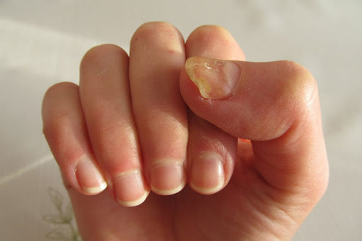 علائم و روش های درمان خانگی عفونت قارچی ناخن های دست و پا