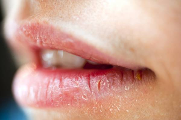 درمان ترک و خشکی لب