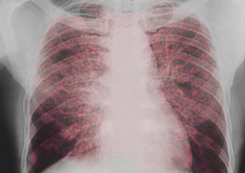 بیماری سارکوئیدوز، تشخیص، علائم و درمان آن