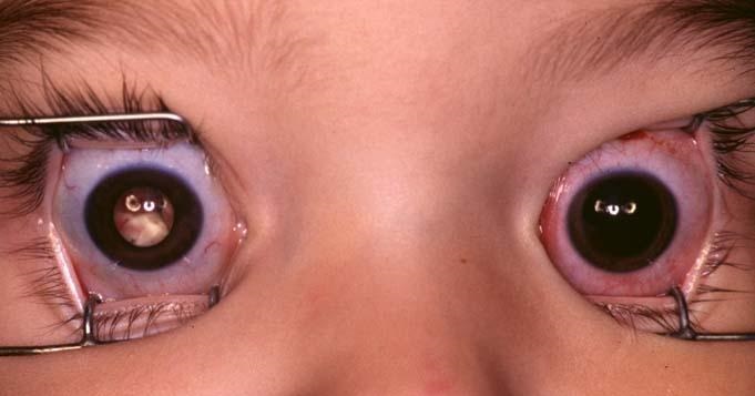 رتینوبلاستوما چیست؟