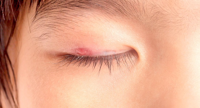 از علت تا درمان سرطان پلک