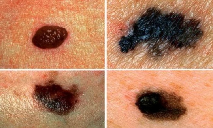 هرآنچه که باید راجع به سرطان پوست بدانیم