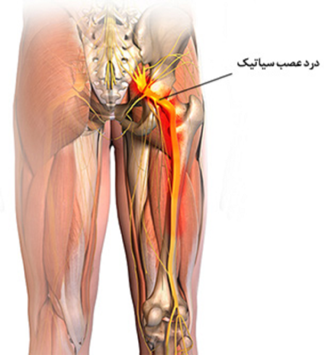 علت درد سیاتیک، علایم ، راه های تشخیص و درمان آن