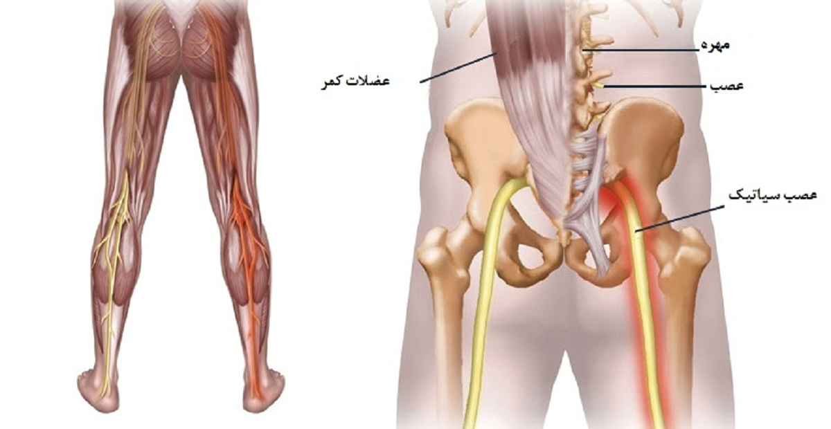 علت درد سیاتیک، علایم ، راه های تشخیص و درمان آن