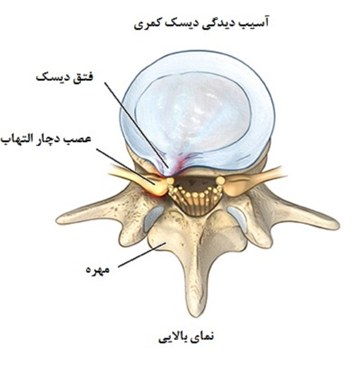 علت درد سیاتیک، علایم ، راه های تشخیص و درمان آن