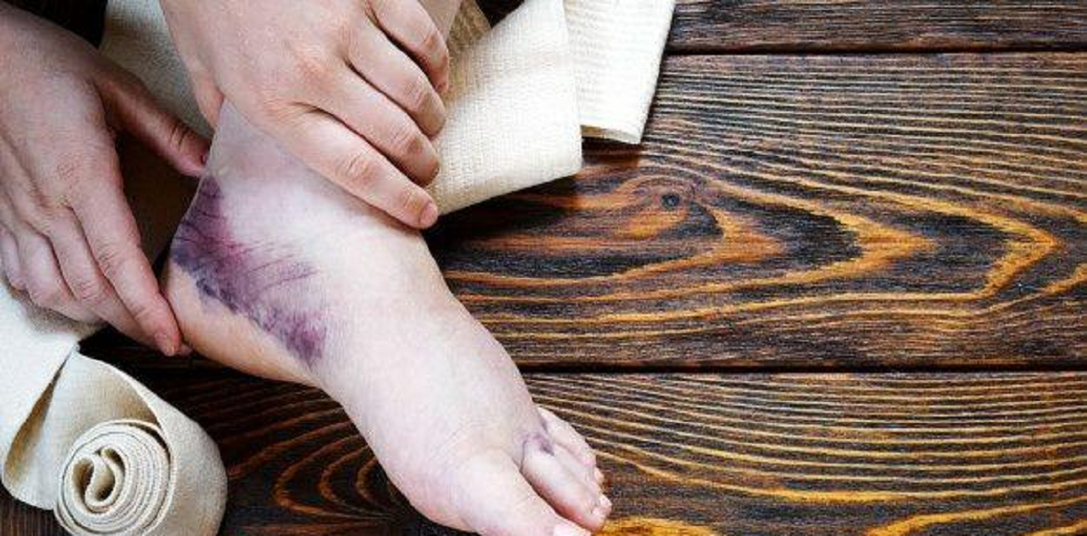 پیچ خوردن و در رفتگی مچ پا علت، علائم و درمان آن