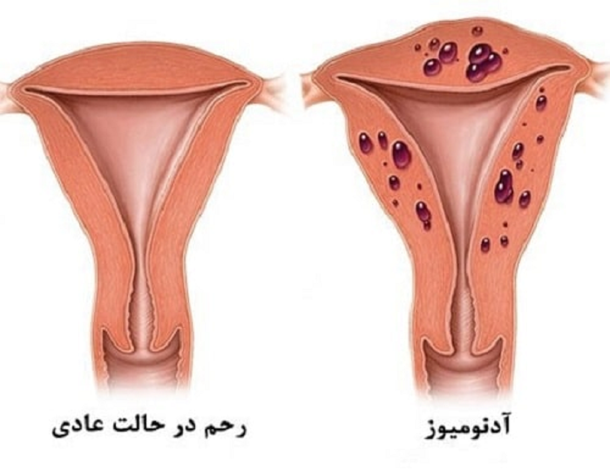 تمام چیزهایی که باید در رابطه با گرفتگی‌های قاعدگی بدانیم
