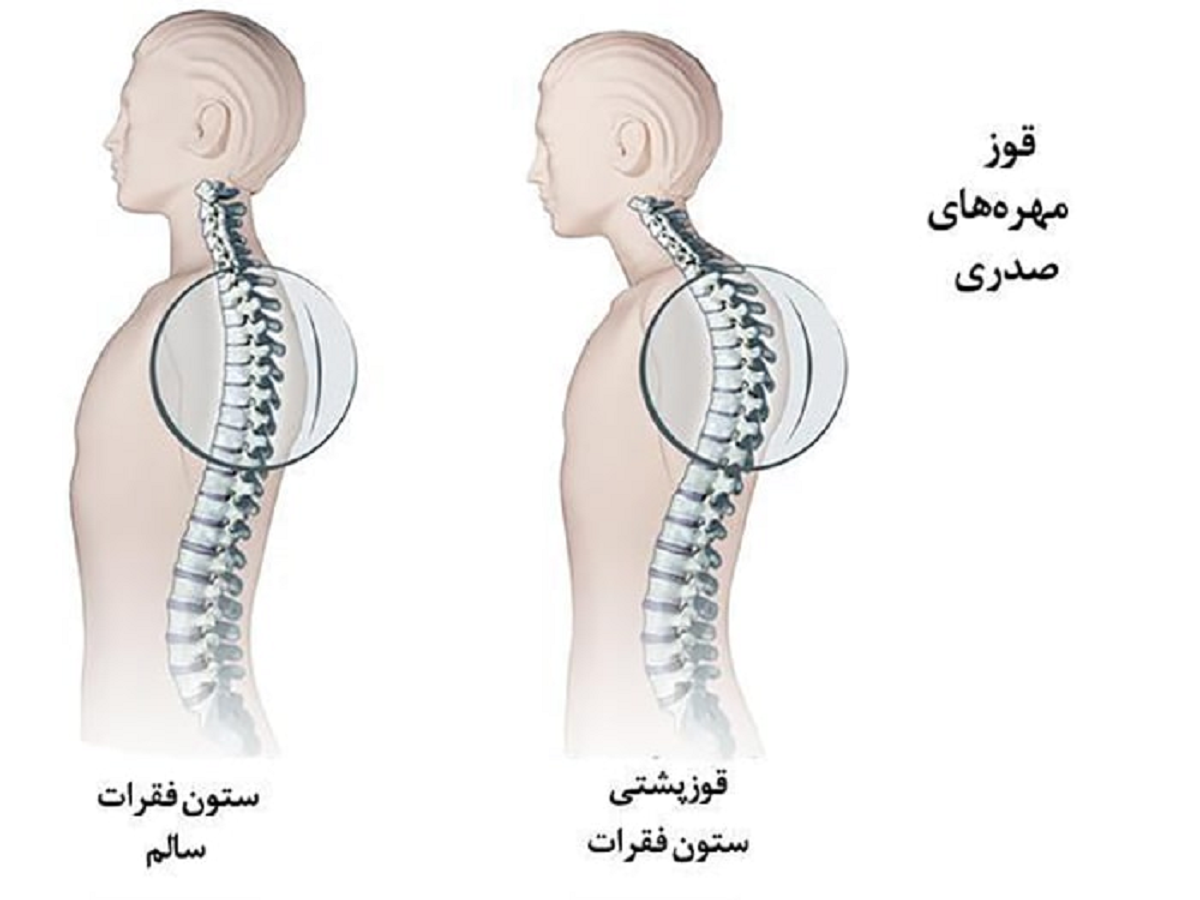 کیفوز یا گوژپشتی چیست و چگونه می توان آن را درمان کرد