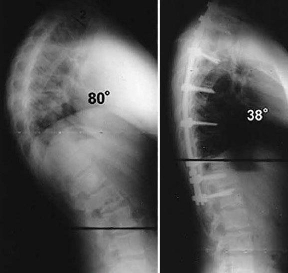 کیفوز یا گوژپشتی چیست و چگونه می توان آن را درمان کرد