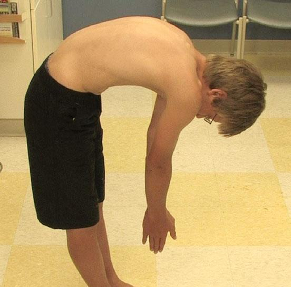 کیفوز یا گوژپشتی چیست و چگونه می توان آن را درمان کرد