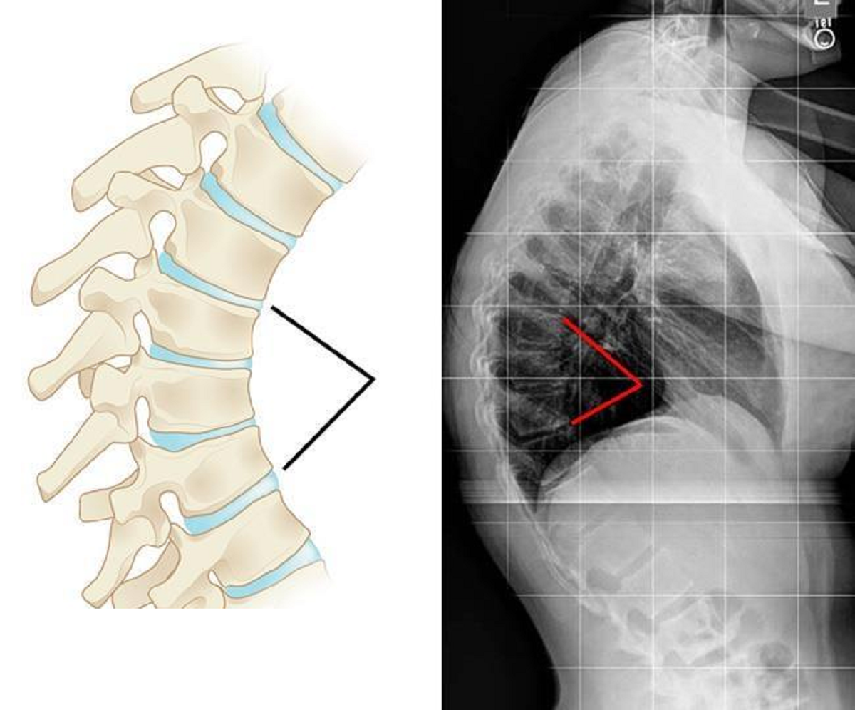 کیفوز یا گوژپشتی چیست و چگونه می توان آن را درمان کرد