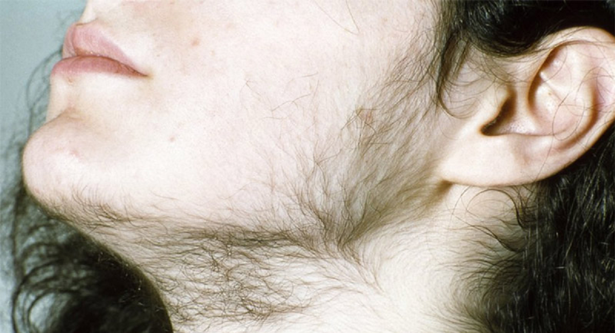 بیماری هیرسوتیسم یا پرمویی و راه های درمان آن