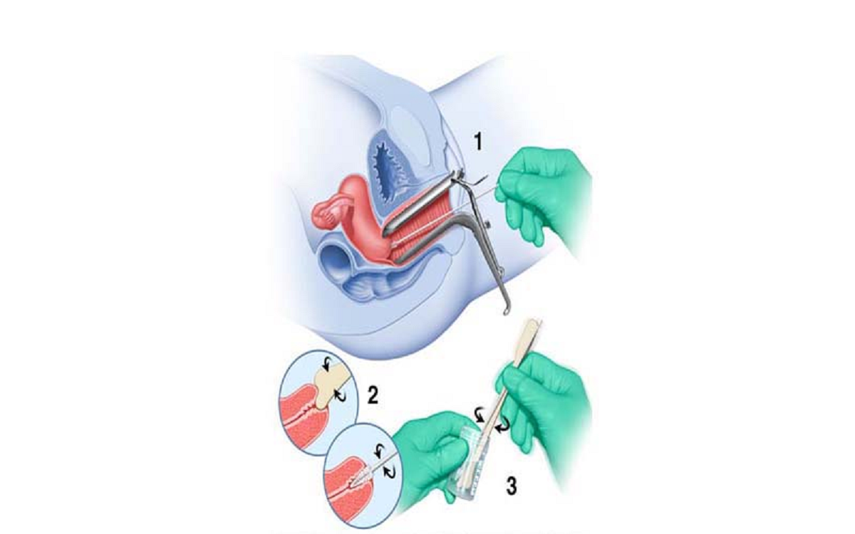 ضرورت انجام تست پاپ اسمیر و نحوه انجام آن