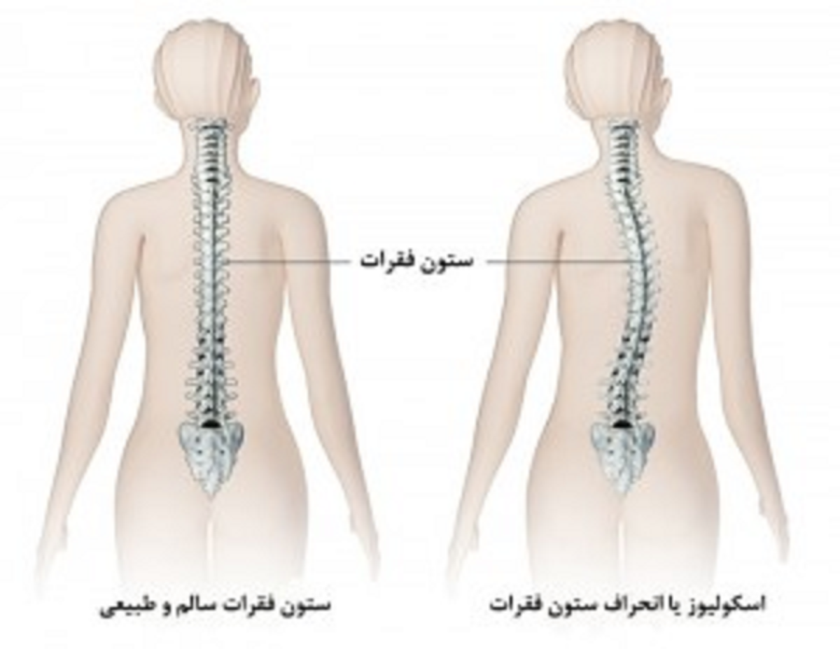 بیماری اسکولیوز یا انحراف ستون فقرات چیست و چگونه درمان می شود