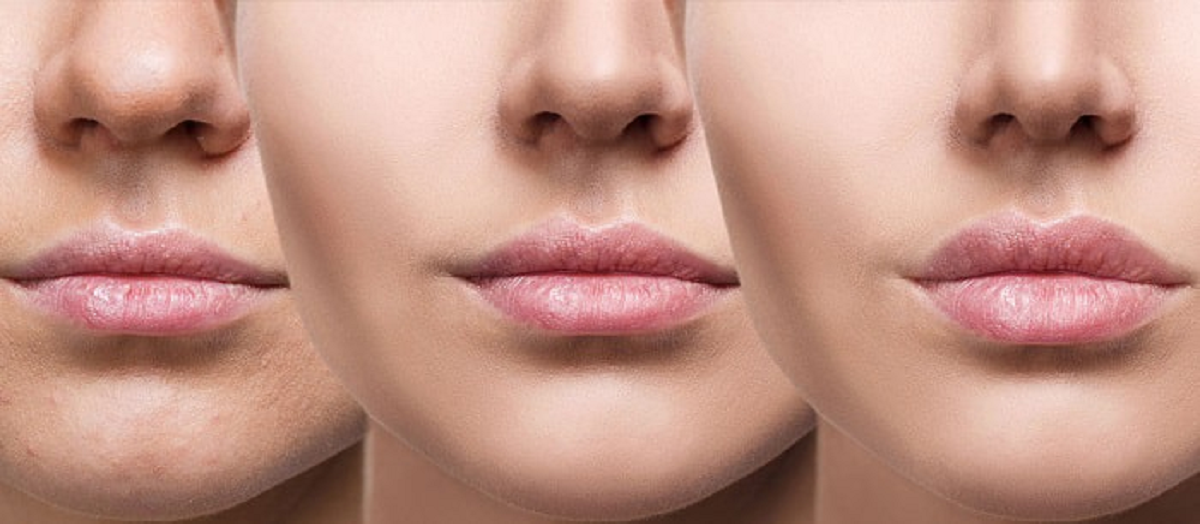 پروتز لب و خطرات احتمالی آن را بشناسید