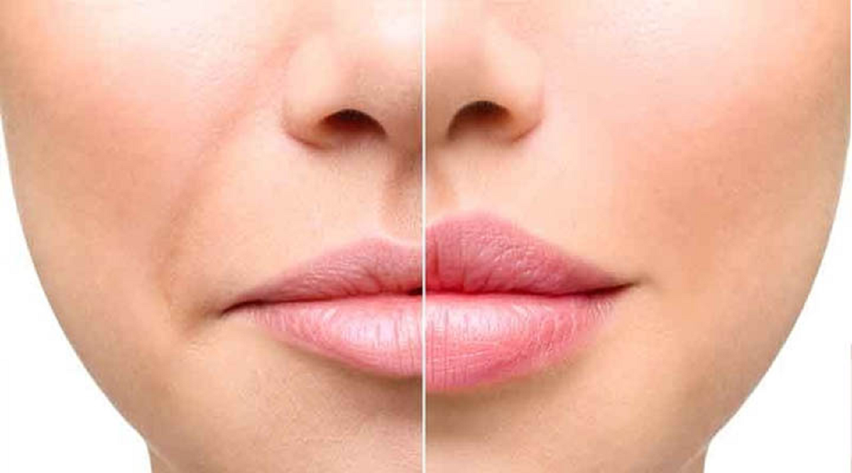 پروتز لب و خطرات احتمالی آن را بشناسید