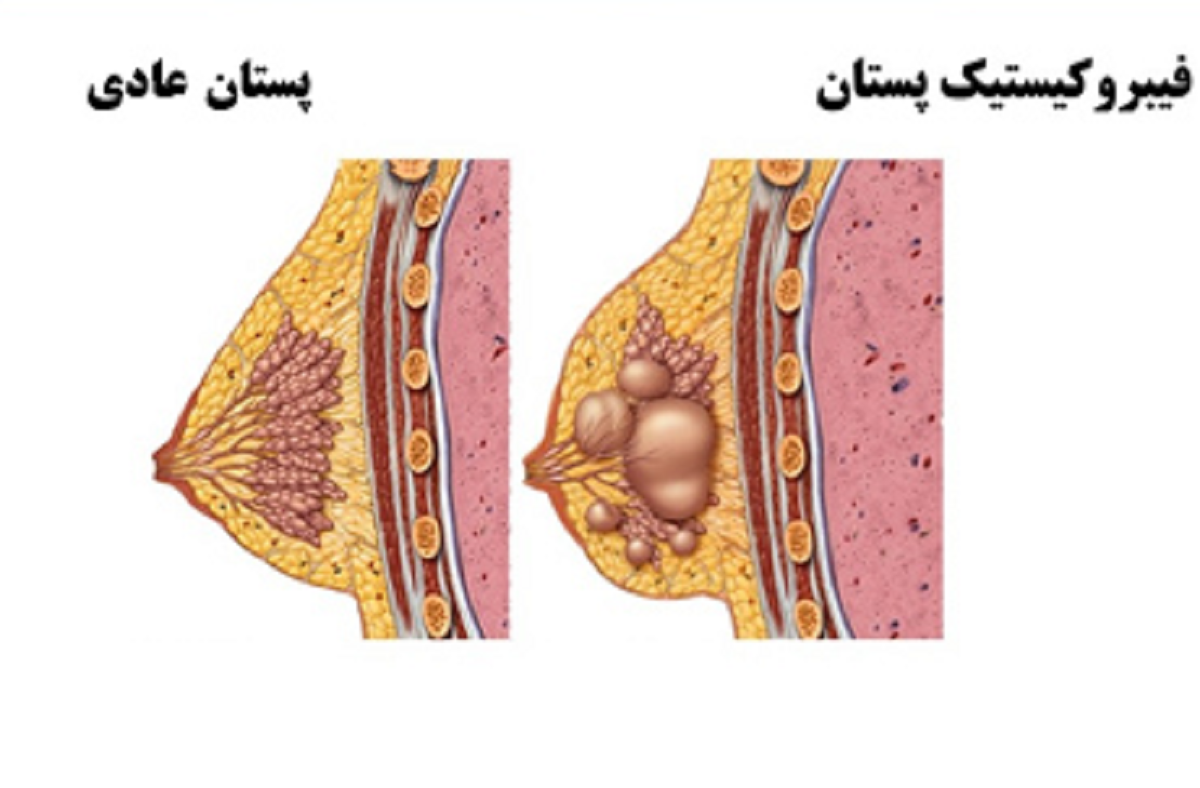 علائم و علت درد سینه در خانمها و روش های درمان آن