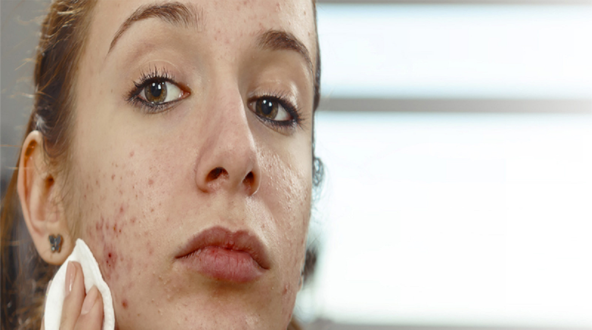 علائم و علل سندرم تخمدان پلی‌کیستیک (PCOS) و تشخیص و درمان آن