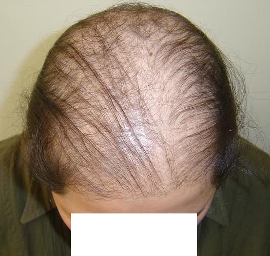 دلایل ریزش مو در جوانی دلایل ریزش مو در جوانی