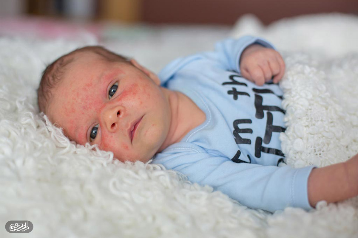 از علت تا درمان آکنه در کودکان