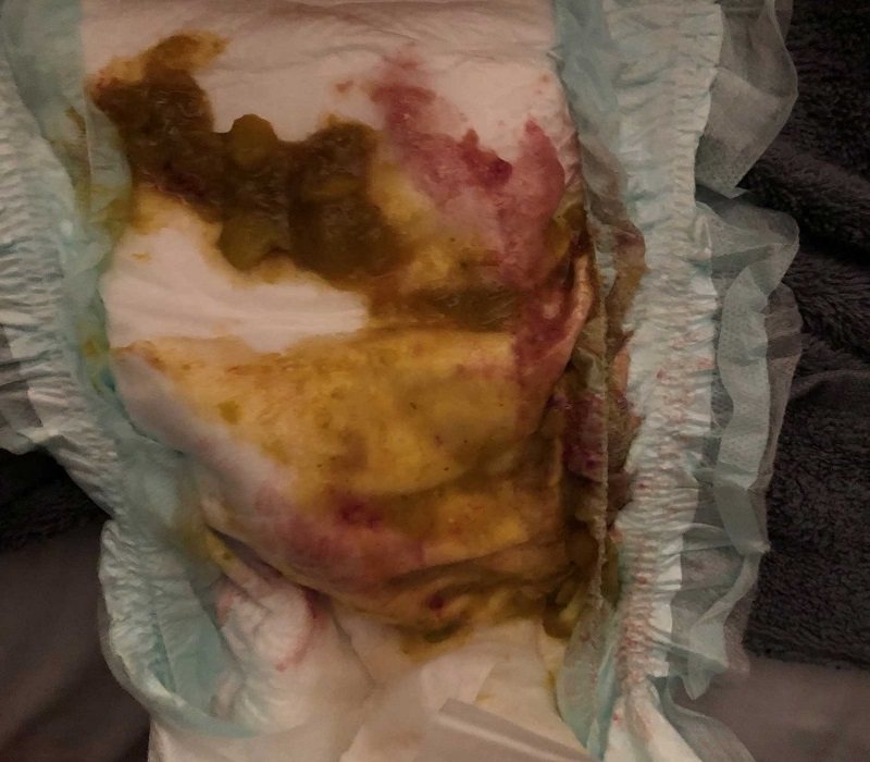 راهنمای تصویری انواع مدفوع نوزاد